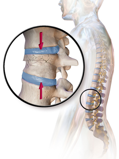 A magnified vertebral body with cracks and loss of height, shown in its position within the spine.