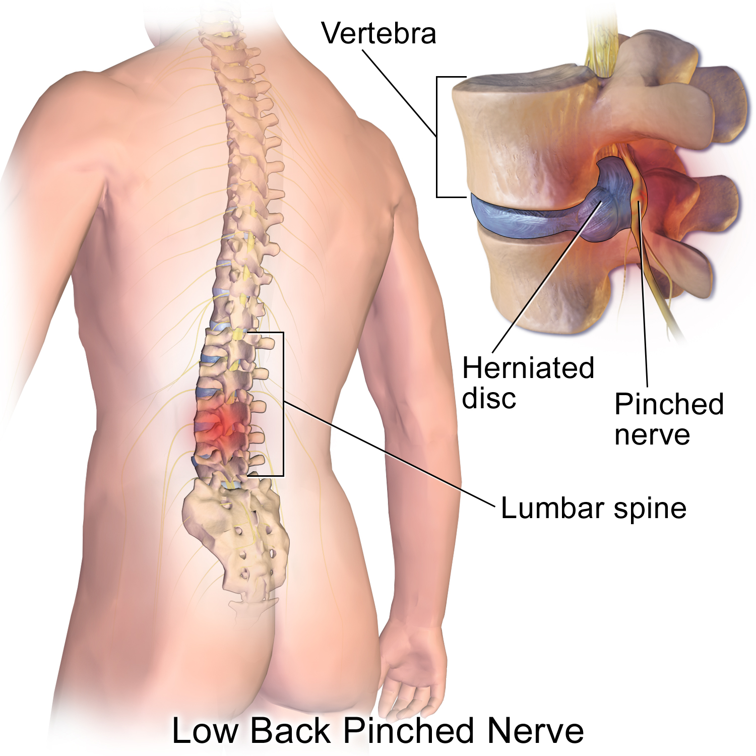 Anatomy illustration of a herniated lumbar disc pressing on a nearby spinal nerve.